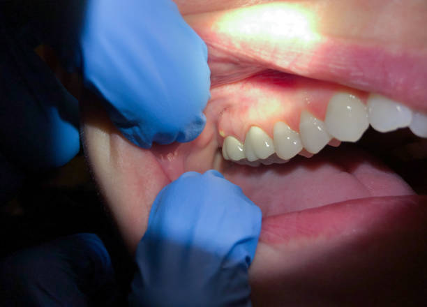 Best Emergency Treatment for Oral Infections in Waterford, WI